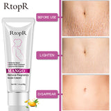 Mango Remove Pregnancy Scars Cream -Stretch Marks Treatment - Tania's Online Closet, LLC